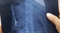 Viveu 18 anos com tesoura no corpo sem dar por nada