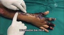 Pele de peixe usada para curar queimaduras graves