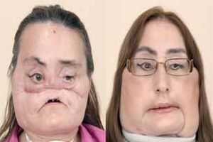 Primeiro transplante facial nos EUA