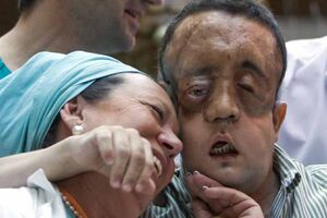 Homem que fez transplante à cara aparece em público (vídeo)