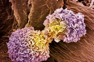 'Conseguimos inibição do tumor de 65%.' Startup desenvolve molécula para cancros agressivos