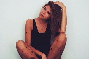A mulher 'dálmata' que virou inspiração nas redes sociais