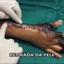 Pele de peixe usada para curar queimaduras graves