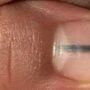 Marca nas unhas revela doença grave 