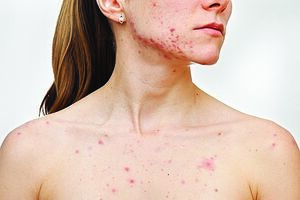 Sarampo manifesta-se através do aparecimento de manchas no corpo 