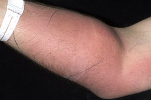 Homem injeta esperma no braço para tratar dor de costas