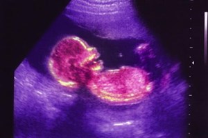 Aborto em caso de trissomia 21. Até quando deve ser possível tomar uma decisão?