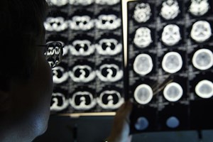Estudo da Universidade do Porto aponta falhas no tratamento de arritmia mais comum