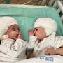 Siamesas israelitas foram separadas e já se podem ver uma à outra
