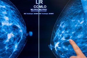 Descoberto mecanismo que diminui dose de fármaco e tem igual benefício no combate ao cancro