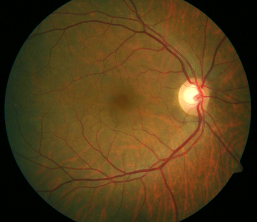 #AdoroOsMeusOlhos: sabe o que é retinopatia diabética?