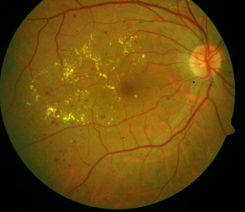 #AdoroOsMeusOlhos: sabe o que é retinopatia diabética?