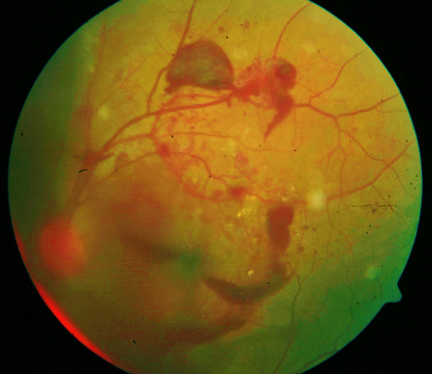 #AdoroOsMeusOlhos: sabe o que é retinopatia diabética?