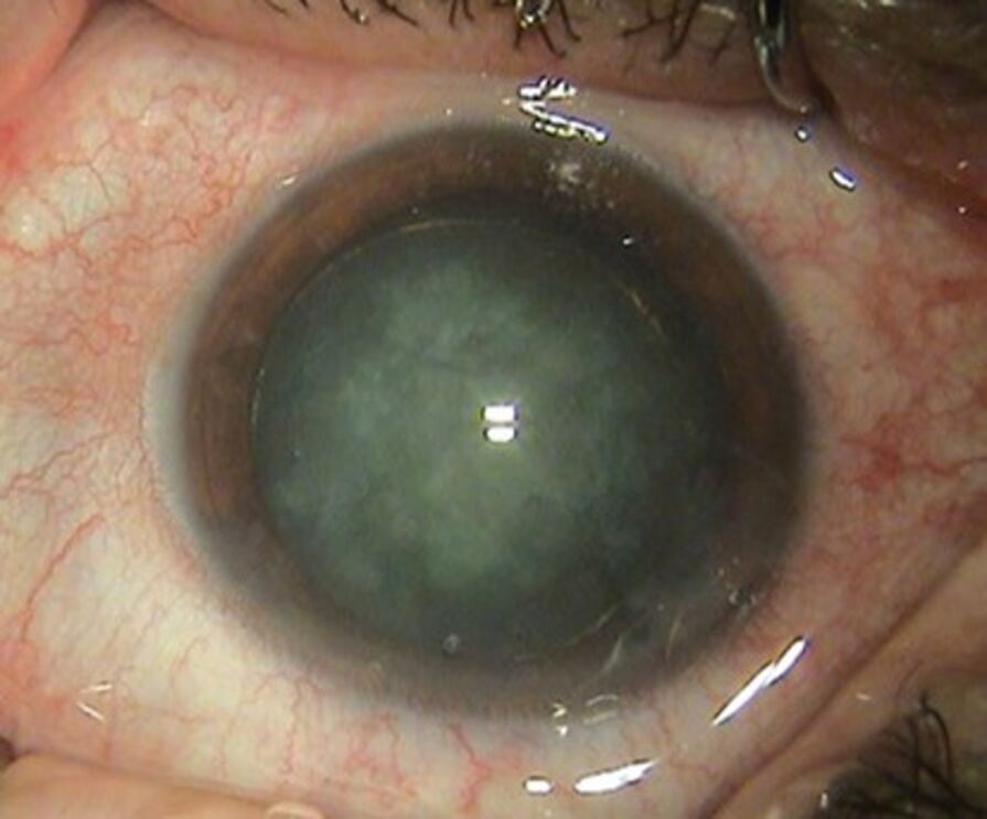 #AdoroOsMeusOlhos – A presbiopia e a catarata