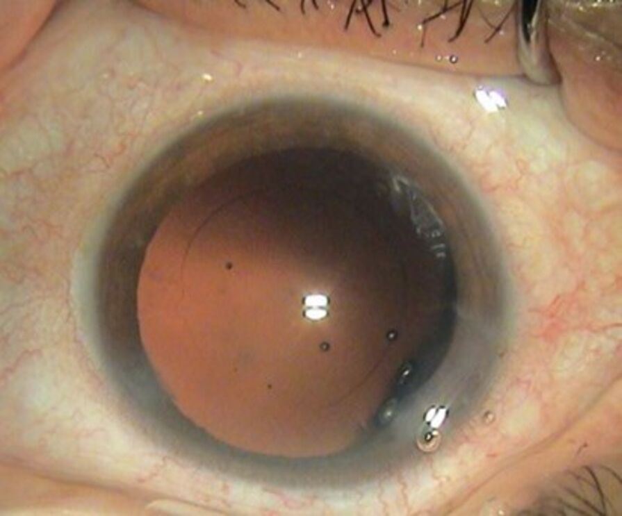 #AdoroOsMeusOlhos – A presbiopia e a catarata