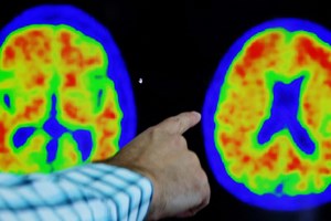 Alzheimer. Vêm aí novos tratamentos?