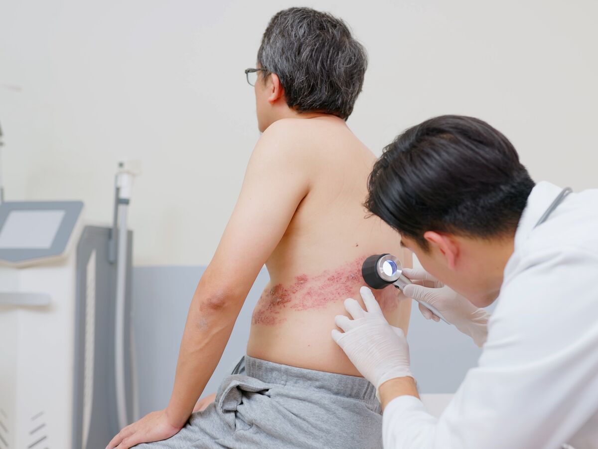 Zona. Isto não é só varicela