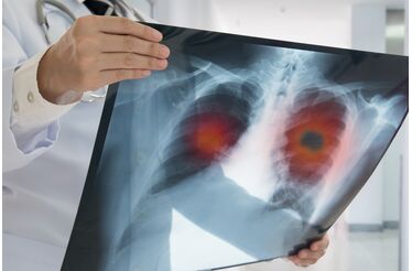 Novas armas contra o cancro do pulmão