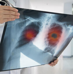 Novas armas contra o cancro do pulmão