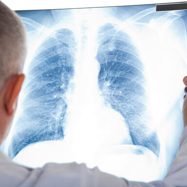 O cancro do pulmão resulta do crescimento descontrolado de células do pulmão