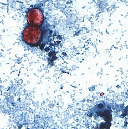 Ciclosporíase: que infeção é esta que já provocou duas mortes no Michigan e 18 mil infetados?