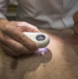Farmacêuticas anunciam resultados positivos para vacina experimental contra melanoma