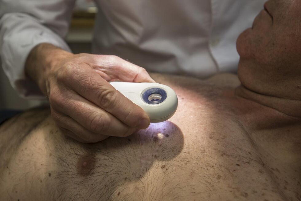 Nova esperança no tratamento do melanoma 