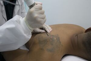 Remoção de tatuagens